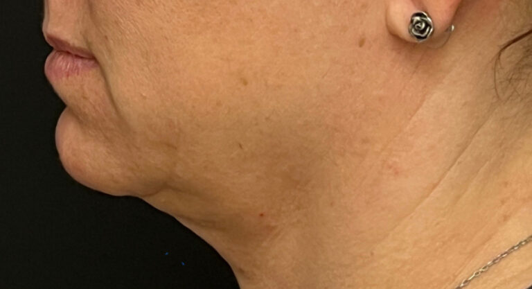 Before Image: Jawline and Chin Filler - left-side