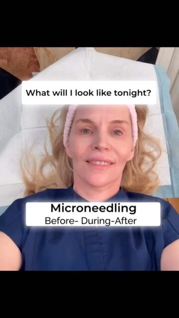 ✨ Microneedling in action ✨

From start to finish, microneedling creates controlled micro-channels in the skin to stimulate your body&rsquo;s natural healing response and support new collagen production.

Benefits may include:

✨ Smoother texture
✨ Softer fine lines
✨ Improved acne scars
✨ Smaller-looking pores
✨ Healthier, more radiant skin

A little red immediately after treatment is completely normal and part of the process. The real magic happens in the weeks that follow as your skin gets to work building fresh collagen.

Ready to invest in healthier skin? Let&rsquo;s create a Beauty Plan that&rsquo;s right for you.

📲 469-388-0303
LINK ALSO IN PROFILE

#FriscoBeautyNurse #Microneedling #CollagenStimulation #microneedling #friscomoms