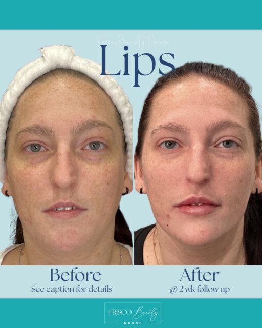 💋 Natural-Looking Lip Enhancement That Complements Your Beauty

A subtle enhancement can make a beautiful difference. This stunning before & after showcases how expertly placed lip filler can enhance shape, definition, symmetry, and volume while maintaining a soft, natural appearance.

At Frisco Beauty Nurse, we believe lip filler should never look overdone. Every treatment is customized to your facial features, lip anatomy, and aesthetic goals to create balanced, beautiful results that look like the best version of you.

✨ Benefits of Lip Filler:
✔️ Enhanced Lip Volume
✔️ Improved Definition & Shape
✔️ Better Symmetry
✔️ Smoother Lip Texture
✔️ Natural-Looking Results

Whether you&rsquo;re looking for a subtle refresh or a fuller pout, our experienced team will create a personalized treatment plan designed specifically for you.

📍 Frisco, TX
Serving Frisco, Prosper, Celina, McKinney, Plano, Allen, Southlake, Westlake, and the surrounding North Dallas communities.

📲 Ready for your own lip transformation? Schedule your consultation today at friscobeautynurse.com.

#FriscoBeautyNurse #LipFillerFrisco #FriscoTXMedSpa #NaturalLipFiller #LipEnhancement