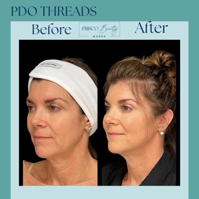 ✨ PDO Threads: Subtle Lift, Natural Rejuvenation ✨

At Frisco Beauty Nurse, this transformation showcases the art of refined, natural-looking facial enhancement using PDO thread lifting&mdash;a minimally invasive treatment designed to lift sagging skin, redefine contours, and stimulate long-term collagen production.

💉 What PDO threads can improve:
✔️ Jawline definition & lower face laxity
✔️ Mid-face lift & cheek support
✔️ Fine lines & early aging changes
✔️ Skin firmness & overall texture

✨ Immediate lift with continued collagen regeneration
✨ No surgery, no added volume&mdash;just structural support
✨ Results that evolve naturally over time

This before & after reflects precision technique and individualized placement for a balanced, refreshed, and lifted appearance&mdash;without compromising natural expression.

📍 Frisco, Texas
🌐 friscobeautynurse.com

#PDOThreadsFrisco #FriscoTXMedSpa #NonSurgicalFacelift #JawlineContourTX #CollagenLiftTx