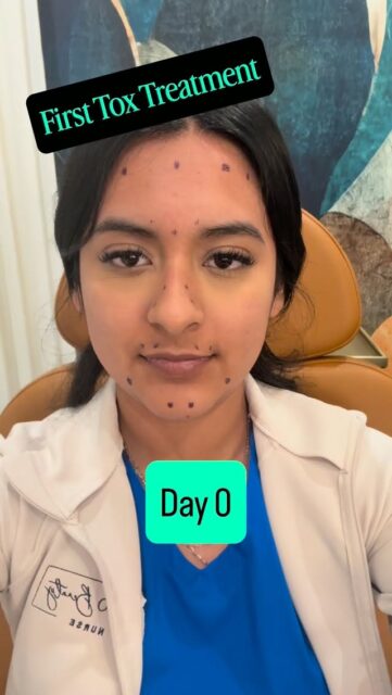 Beautiful before. ✨ Refreshed now.

Maritza is in her 20s, and today&rsquo;s treatment wasn&rsquo;t about changing her face&mdash;it was about preserving it.

Our goals:
💉 Smooth her forehead
✨ Help prevent those &ldquo;11&rdquo; lines from becoming etched in
👁️ Soften crow&rsquo;s feet
👃 Slim the appearance of her nose with facial expression
😊 Lift the corners of her mouth
💎 Smooth chin dimpling with movement

The best aesthetic treatments don&rsquo;t make people wonder what you had done. They simply make you look rested, refreshed, and like the best version of yourself.

Starting with small, strategic treatments now can help slow the formation of deeper expression lines over time, so you&rsquo;re maintaining your results rather than trying to reverse years of aging later.

This is what I love most about aesthetics&hellip; building on the beauty that&rsquo;s already there. 🤍

#Xeomin #PreventativeBotox #PreventativeTox #NaturalResults #FriscoBeautyNurse AestheticNurse WrinkleRelaxer HealthyAging