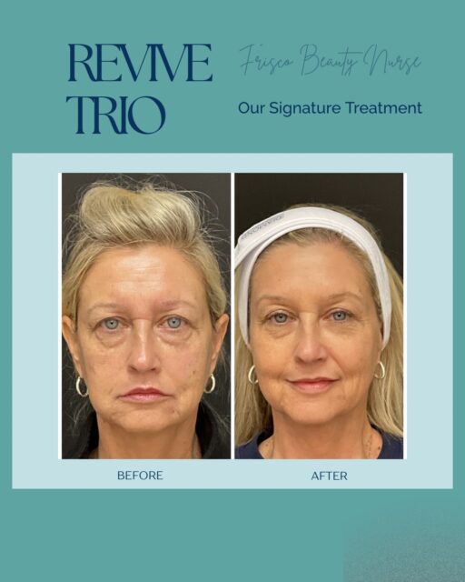 My Revive Trio combines:
💉 Three strategically selected dermal fillers
👩&zwj;⚕️ Years of advanced aesthetic expertise
✨ A customized plan that restores balance, structure, and youthful contours while still looking like you.

The goal is never to make you look &ldquo;done.&rdquo;
It&rsquo;s to have friends tell you:
&ldquo;You look amazing&hellip; what have you been doing?&rdquo;

This is one of my favorite treatments because it delivers one of the biggest transformations for the investment while keeping results elegant, natural, and beautifully refreshed.

Ready to discover what your Revive Trio could do?
📲 Schedule your Facial Rejuvenation Assessment + Personalized Beauty Plan, and let&rsquo;s create a treatment plan that&rsquo;s designed specifically for you.

💙 Building on the beauty of you.

#FriscoBeautyNurse #ReviveTrio #FacialBalancing #NaturalResults #DermalFillers FullFaceRejuvenation LuxuryAesthetics FriscoTX NurseInjector FacialHarmony AestheticMedicine LookRefreshedNotDone