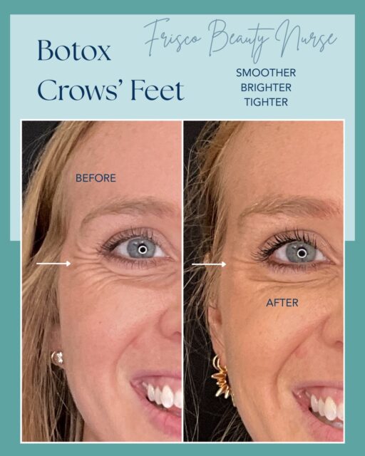 ✨ Botox Before & After | Natural Results You&rsquo;ll Love 💉

Real results. Thoughtful injections. Beautifully natural outcomes. 🤍

These before & after photos showcase how expertly placed Botox can soften dynamic wrinkles while preserving your natural expressions.

✔️ Smooth Forehead Lines
✔️ Relax Frown Lines (Glabella/&ldquo;11s&rdquo;)
✔️ Reduce Crow&rsquo;s Feet
✔️ Refresh Your Appearance&mdash;Never Overdone

At Frisco Beauty Nurse, every treatment is customized to your facial anatomy and aesthetic goals. The result? A smoother, brighter, more refreshed version of YOU&mdash;not someone else. Our clinician-led approach focuses on precision, balance, and natural-looking enhancements that help you look rested and confident. 

✨ Schedule your personalized Botox consultation today and discover why Frisco Beauty Nurse is trusted for subtle, elegant results.

📍 Frisco, TX
📲 Book Online Today

#BotoxFrisco #FriscoBeautyNurse #NaturalBotox #BeforeAndAfter #AestheticNurse

👉 Tap Book Now to schedule your consultation and experience the Frisco Beauty Nurse difference.
