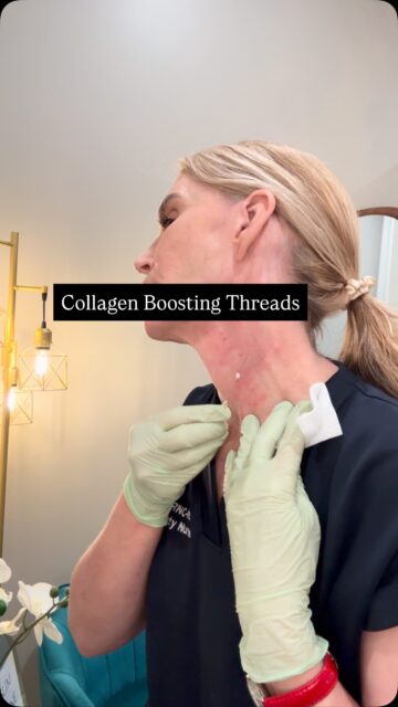 Thin, Tiny, and Mighty
Collagen boosting threads

As a woman over 50, this is my favorite treatment to maintain skin quality

Want to know more, DM &ldquo;threads&rdquo; 

#pdothreads #pdothreadsexpert #eurothreadlift #threadliftfrisco