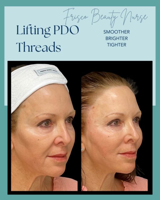 A beautiful result should never be obvious.

It should simply look&hellip; effortless.

PDO Threads offer a refined approach to facial rejuvenation&mdash;lifting, supporting, and stimulating collagen to restore youthful definition while preserving the features that make you uniquely you.

Performed by Carla Marchand, RN, RNC-NIC&mdash;a National Trainer for EuroThreads&reg;, creator of the Threadnique&trade; technique, and trusted educator in aesthetic medicine&mdash;every treatment is guided by decades of experience and an unwavering commitment to natural results.

Because artistry isn&rsquo;t about transformation.

It&rsquo;s about knowing exactly how little to do.

✨ The Frisco Beauty Nurse difference.

🌐 friscobeautynurse.com

#FriscoBeautyNurse #PDOThreadLift #NaturalResults #LuxuryAesthetics #CollagenStimulation