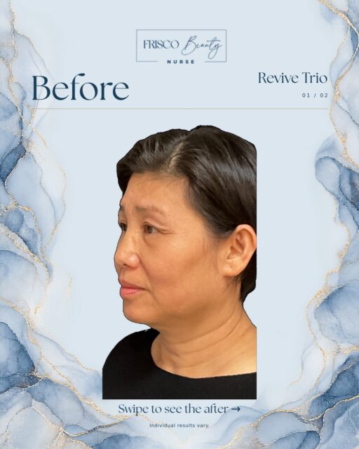 Rejuvenation should never erase the character of a face. It should reveal it more beautifully. ✨

This Revive Trio&trade; before & after reflects Carla&rsquo;s signature approach to facial rejuvenation: treating the face as a whole, with careful attention to anatomy, proportion, and the subtle changes that occur over time.

Rather than focusing on a single feature, the treatment is thoughtfully designed to restore harmony across the face&mdash;softening visible fatigue, supporting areas where structure has diminished, and creating a more rested, refined appearance without looking overdone.

The result is not a different face.

It is her face&mdash;more balanced, more refreshed, and still entirely her.

That is the artistry behind the Revive Trio&trade;.

Building on the beauty of you. 🤍

📍 Frisco, Texas
🌐 friscobeautynurse.com

Individual results vary.

#FriscoBeautyNurse #ReviveTrio #FacialBalancing #FriscoAesthetics #NaturalRejuvenation