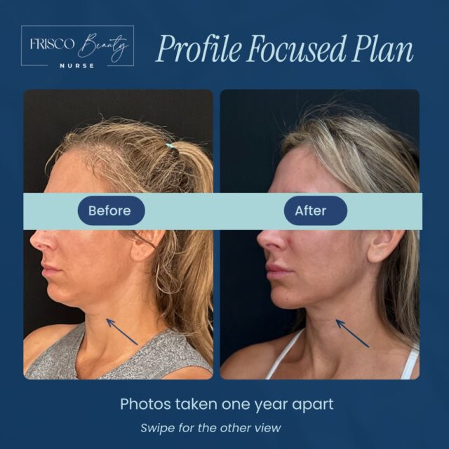 Kybella was the star of the show here. ✨

I love this before and after because it shows how a personalized Beauty Plan can come together over time.

We started with two Kybella treatments to reduce fat beneath her chin. Botox was also part of her lower-face treatment plan. Filler came last&mdash;a minimal amount in the chin and prejowl area that made an impactful finishing touch. The cherry on top. 🍒

You may have noticed a subtle change in her lips, too&mdash;a small amount of lip filler completed her plan.

These photos were taken one year apart. Thoughtful treatment, in stages, with each step serving a purpose.

Curious about your own Beauty Plan? Reserve a time especially for you at Frisco Beauty Nurse in Frisco, Texas. Tap the link in our bio to get started.

Individual results vary.

#FriscoBeautyNurse #KybellaFrisco #ChinFillerFrisco #FriscoTexas #FacialBalancing