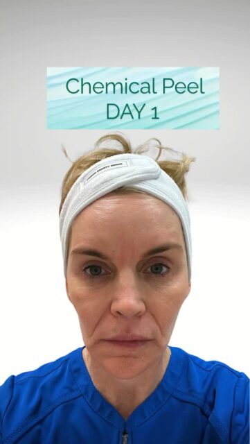 ✨ 5 Days. One Chemical Peel. A Beautiful Skin Reset!

Ever wonder what your skin goes through after a medium-depth chemical peel? Here&rsquo;s a day-by-day look at the process&mdash;from dryness and peeling to smoother, brighter, more radiant skin! 💙

The secret? Trust the process and DON&rsquo;T pick the peel! 😉

Fall is the perfect time to tackle sun damage, uneven skin tone, and rough texture.

✨ Ready for your own skin refresh? Reserve a time especially for you at Frisco Beauty Nurse!

📍 Frisco, TX
📲 469-388-0303
🔗 Link in bio

#FriscoBeautyNurse #ChemicalPeel #FriscoTX #FriscoMedSpa #SkinRejuvenation