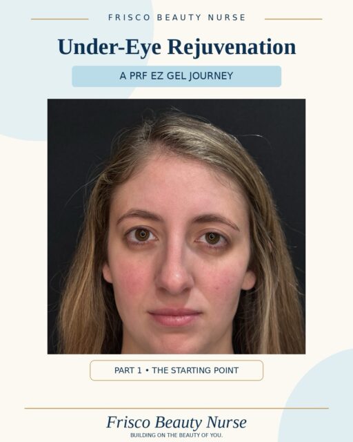 ✨ PRF EZ Gel Under-Eye Rejuvenation in Frisco, TX | Part 1

Do under-eye hollows or dark circles make you look tired, even when you&rsquo;re not?

At Frisco Beauty Nurse, we offer PRF EZ Gel as a natural, regenerative option to help improve the appearance of under-eye hollowness and create a softer, more rested look.

💙 Follow this patient&rsquo;s under-eye rejuvenation journey!

Her BEFORE photo shows the hollowness and shadows beneath her eyes.

Her AFTER photo? Taken literally at checkout, just minutes after her first PRF EZ Gel treatment!

And here&rsquo;s what&rsquo;s important: This is NOT her final result.

PRF EZ Gel is created using components of your own blood. It provides soft tissue support while encouraging gradual skin rejuvenation over time.

✨ Why we&rsquo;re sharing the journey:

Our treatment plan includes two sessions approximately one month apart. She&rsquo;ll return in a couple of weeks for her second treatment, and we&rsquo;ll continue documenting her progress.

You&rsquo;ll get to see what happens immediately after treatment, how her under-eyes settle, and how her results develop.

Because beautiful, natural-looking results are about the process, not just the finished photo.

Looking for under-eye rejuvenation in Frisco, Prosper, McKinney, or Plano?

Reserve a consultation at Frisco Beauty Nurse to learn whether PRF EZ Gel is an appropriate option for your unique anatomy and aesthetic goals.

📍 Frisco Beauty Nurse | Frisco, Texas
🔗 friscobeautynurse.com
💙 Building on the Beauty of You.

Individual results vary. Immediate post-treatment appearance may include temporary swelling.

#FriscoBeautyNurse #PRFEZGel #UnderEyeRejuvenation #FriscoMedSpa #FriscoTX
