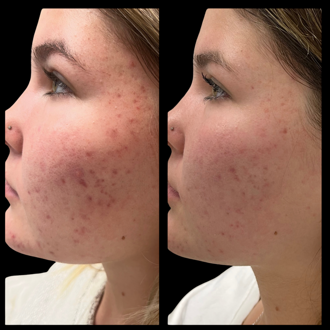 Acne scar treatment results at Frisco Beauty Nurse