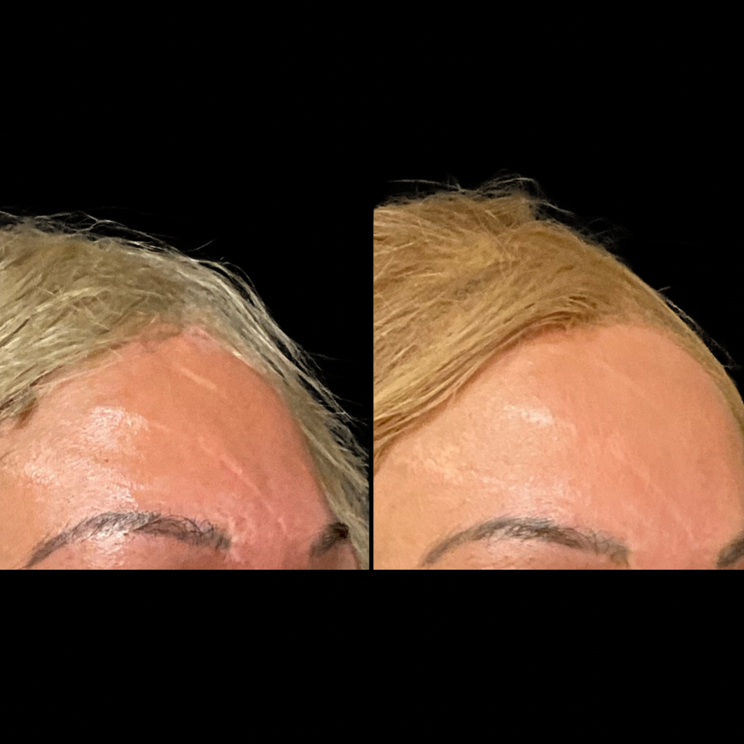 EuroThreads PDO threadlift results