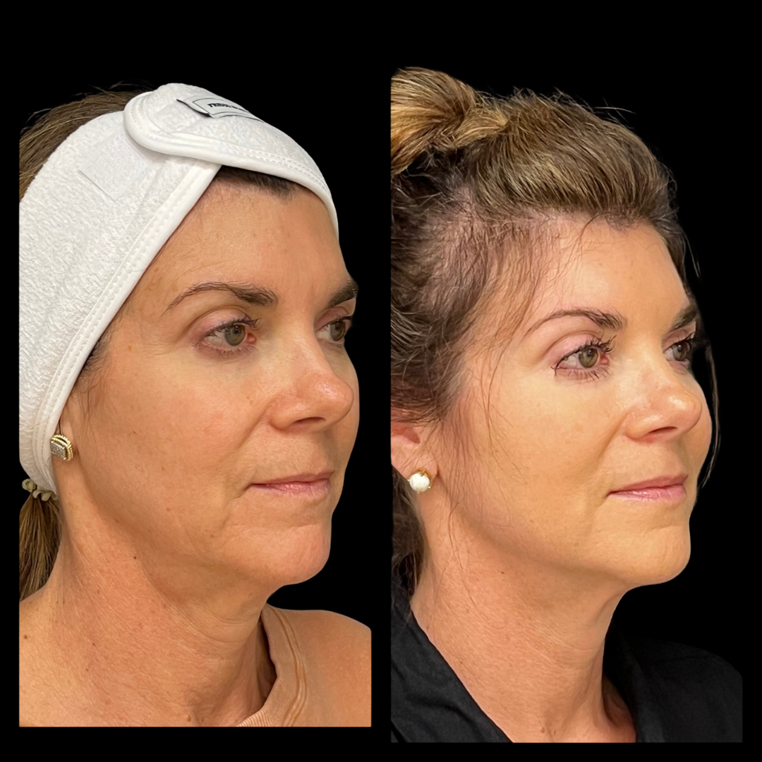 Age spots and uneven tone treatment planning in Frisco TX