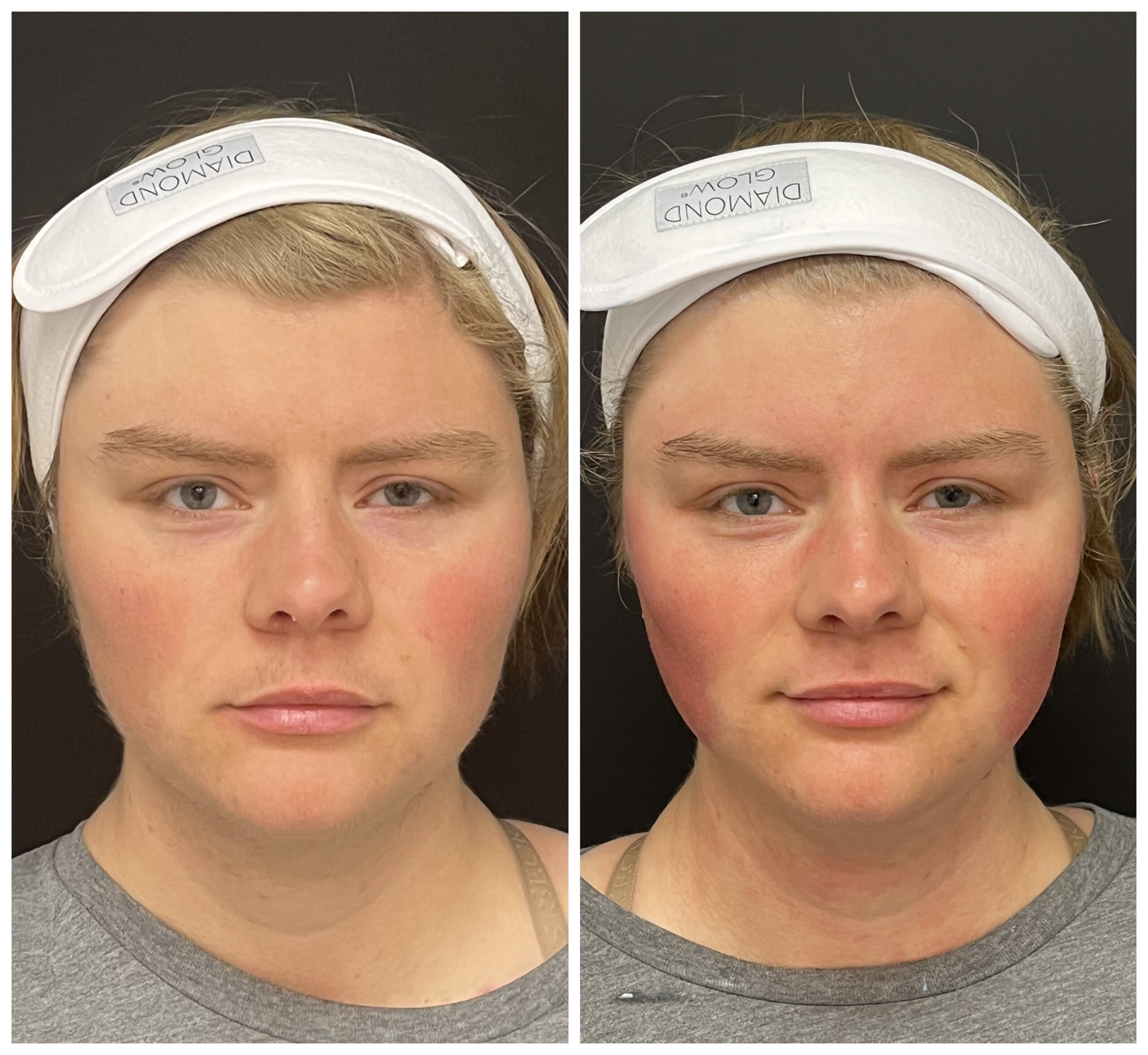 DiamondGlow facial treatment at Frisco Beauty Nurse