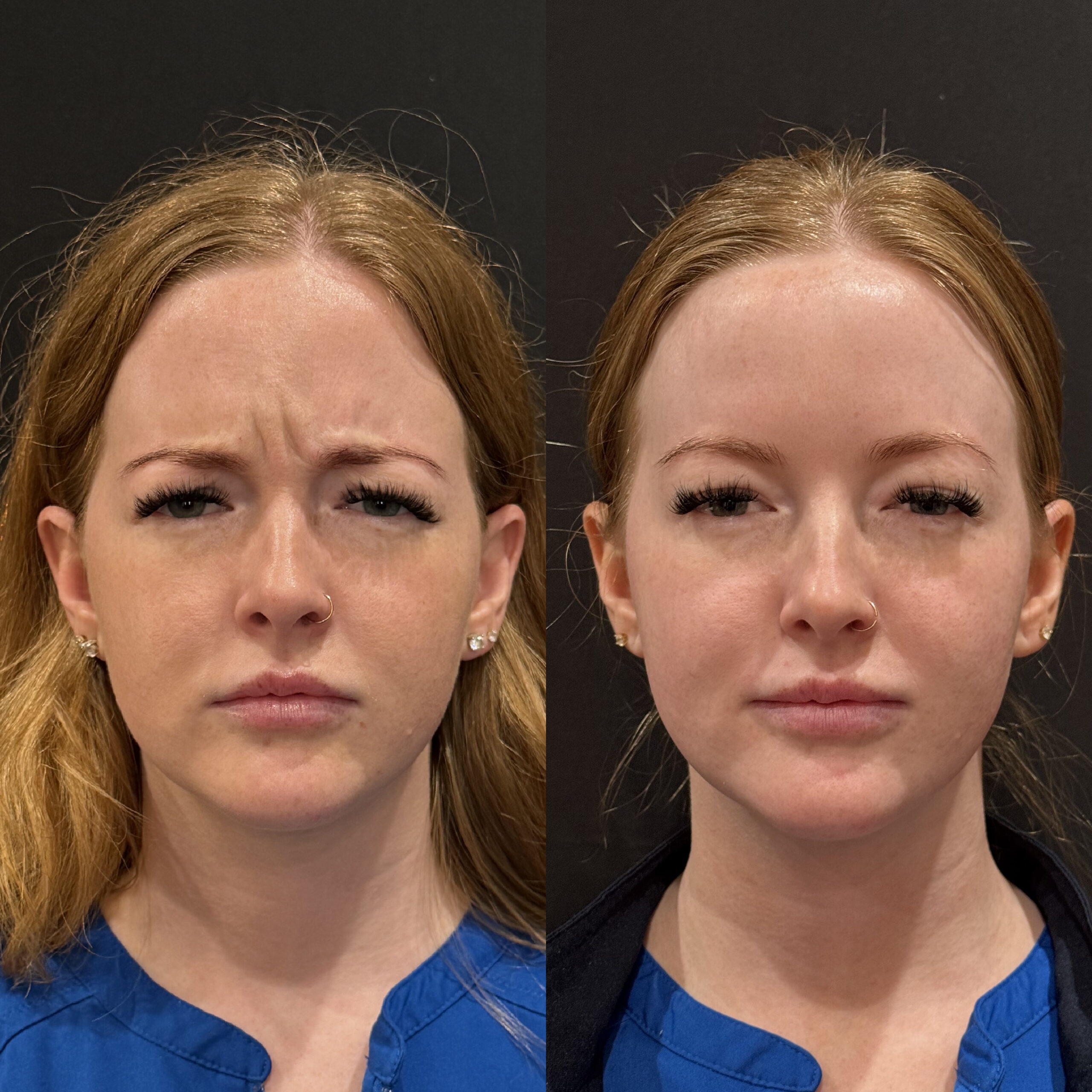 Xeomin vs Botox vs Dysport treatment options in Frisco TX