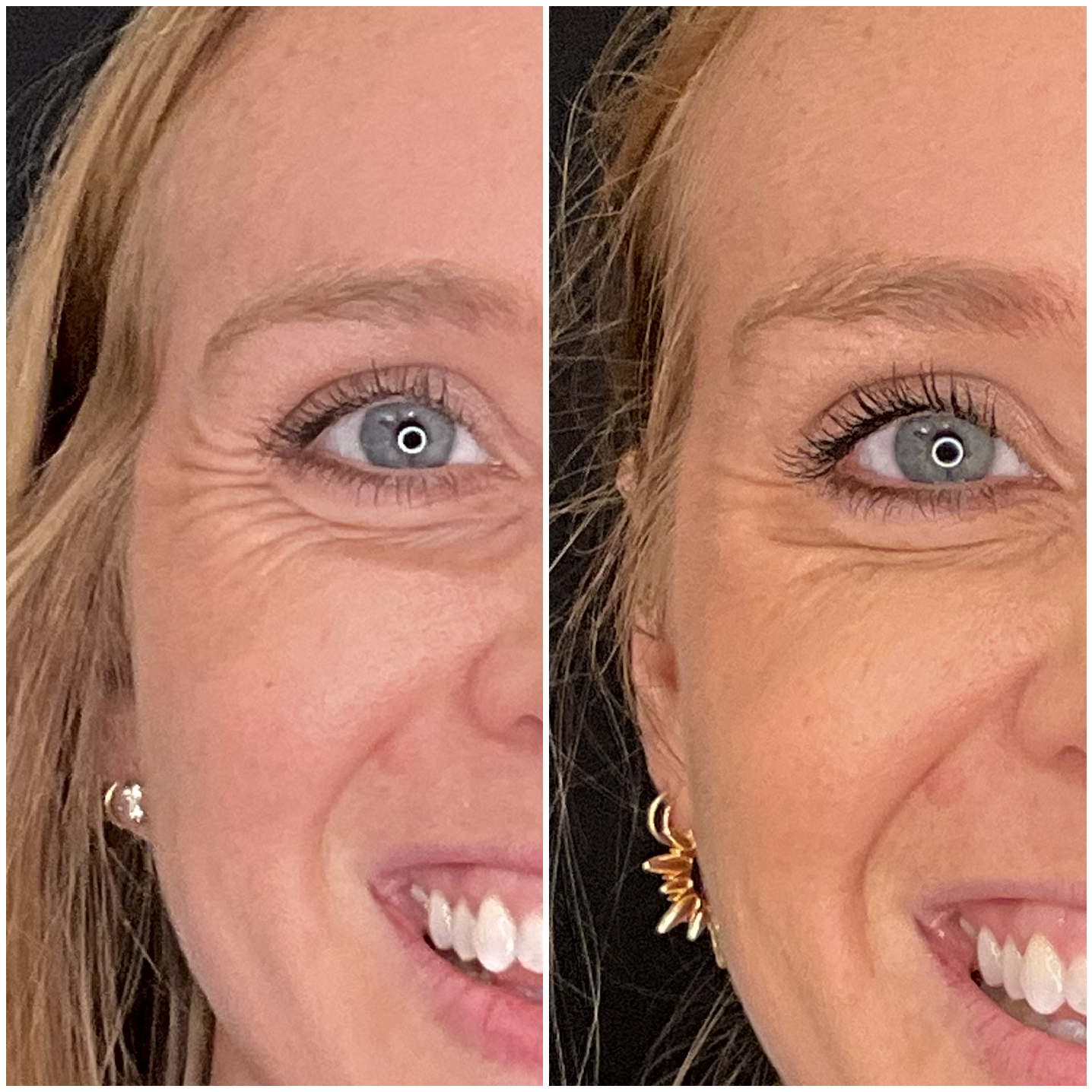 Dysport treatment results at Frisco Beauty Nurse