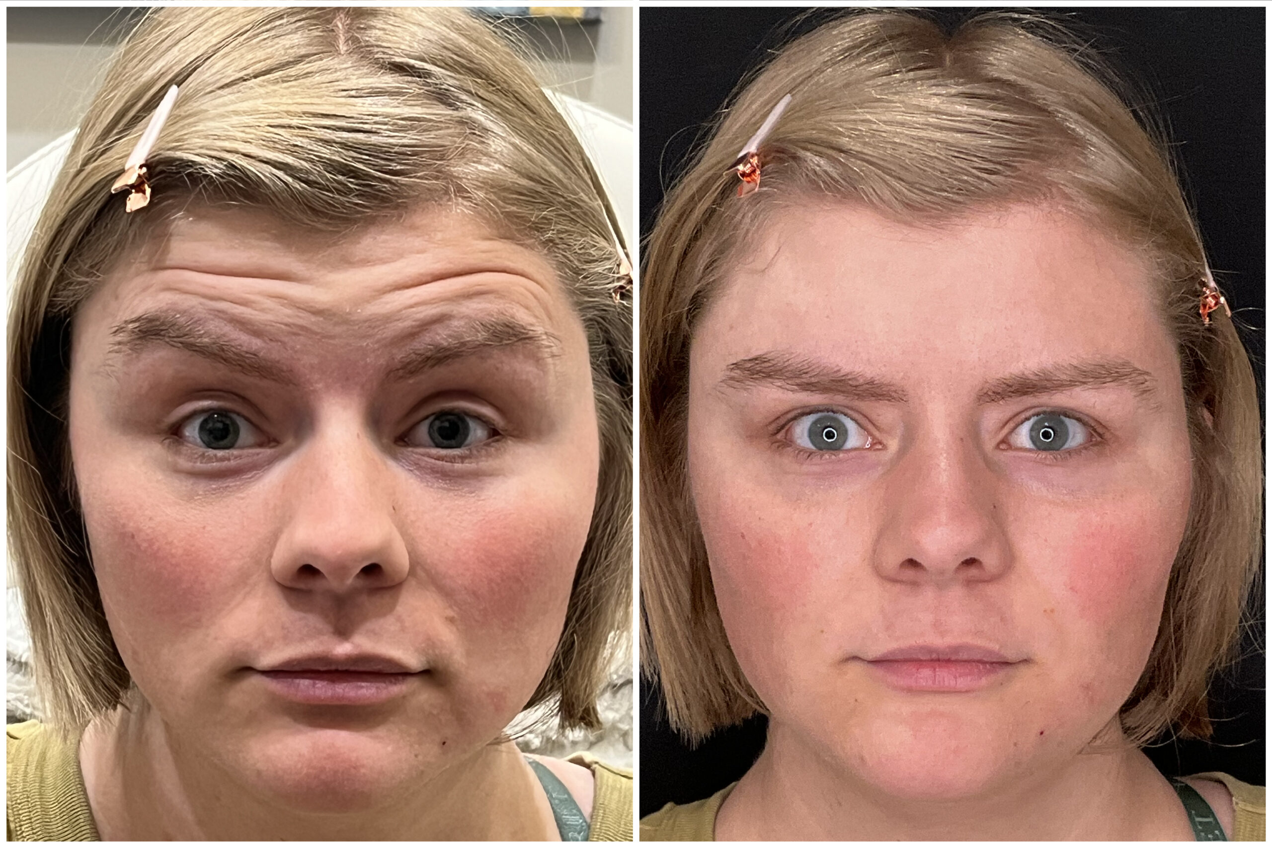 How long Botox Dysport and Xeomin last in Frisco TX