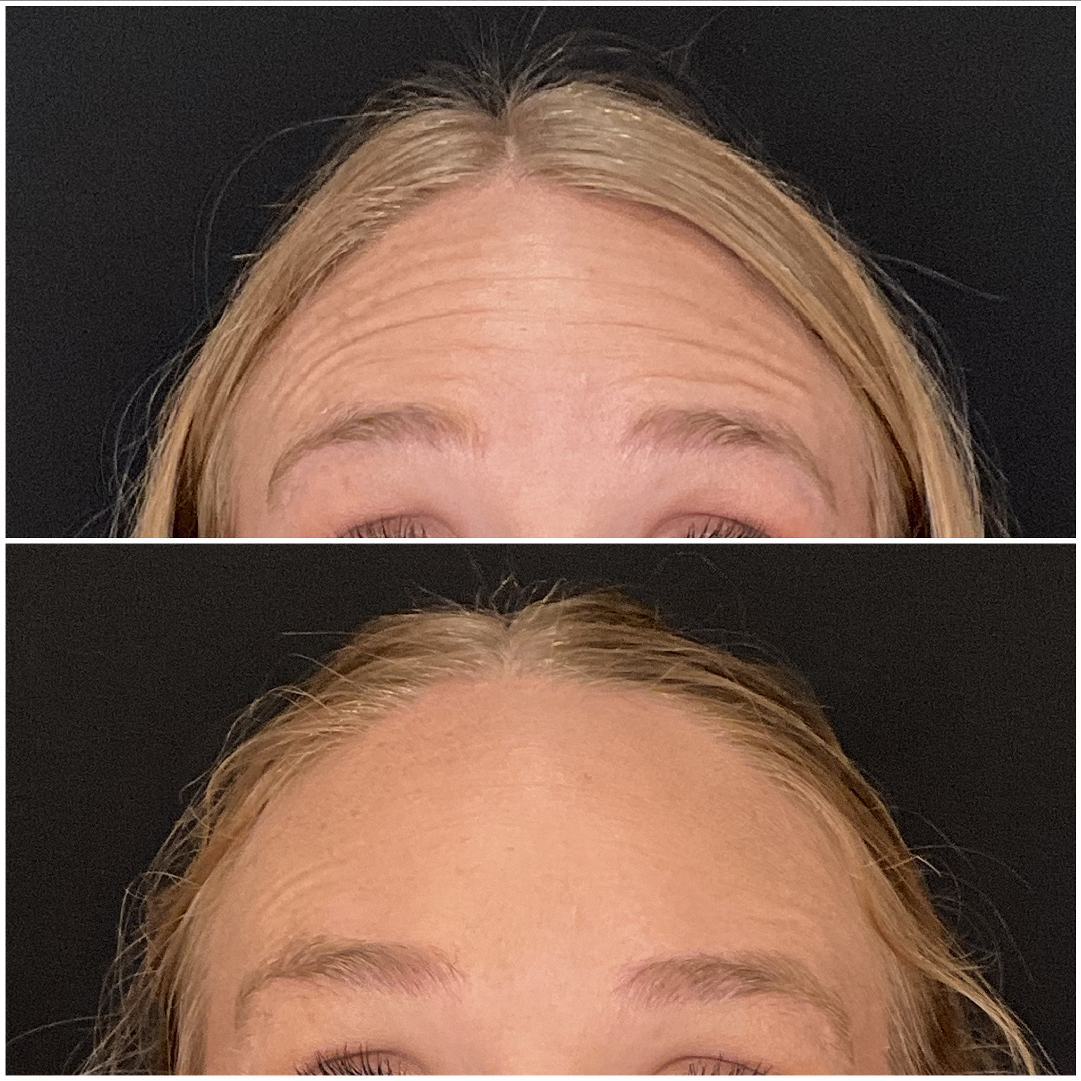 Forehead wrinkle relaxer results at Frisco Beauty Nurse
