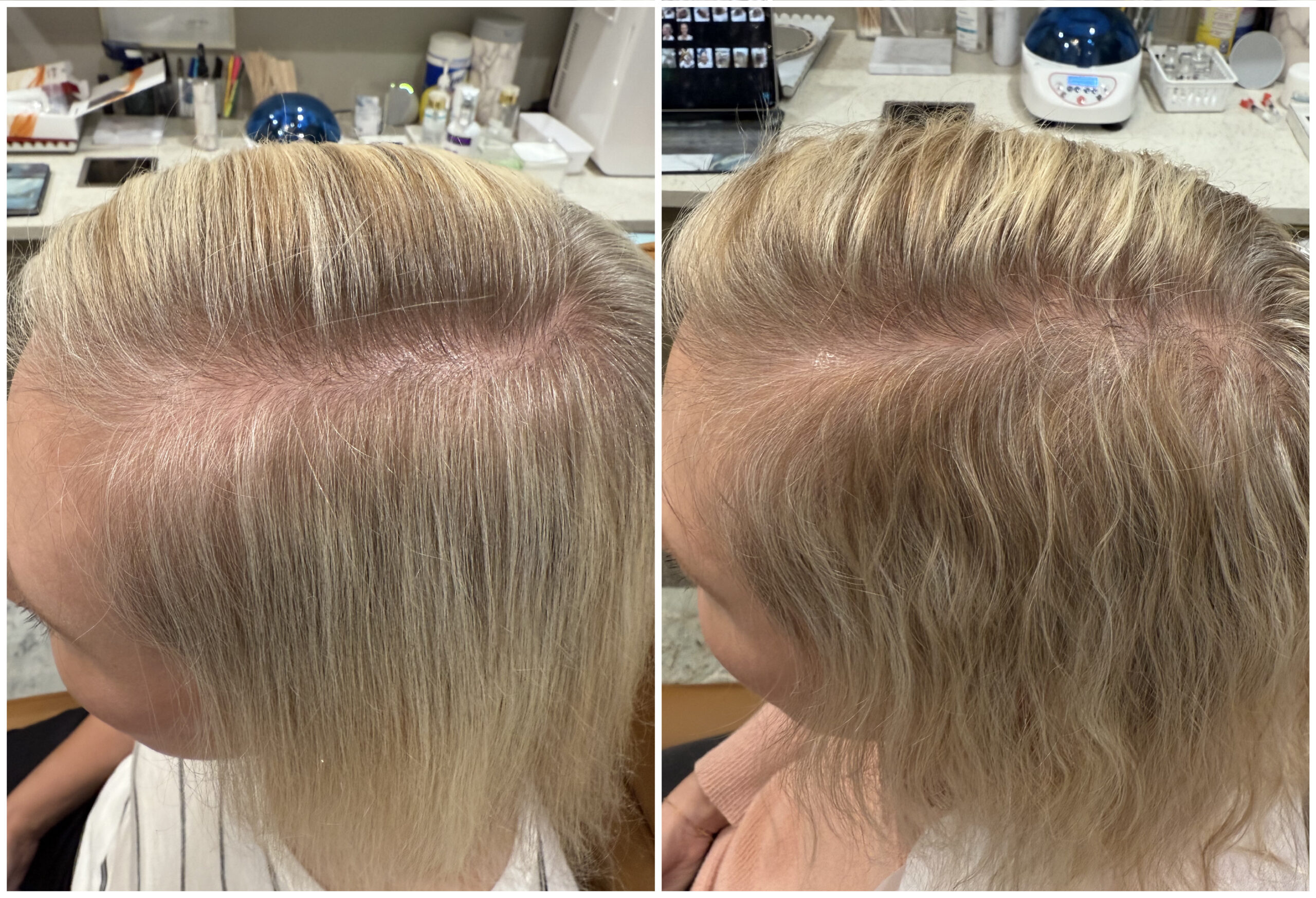 Platelet-rich plasma preparation for hair restoration