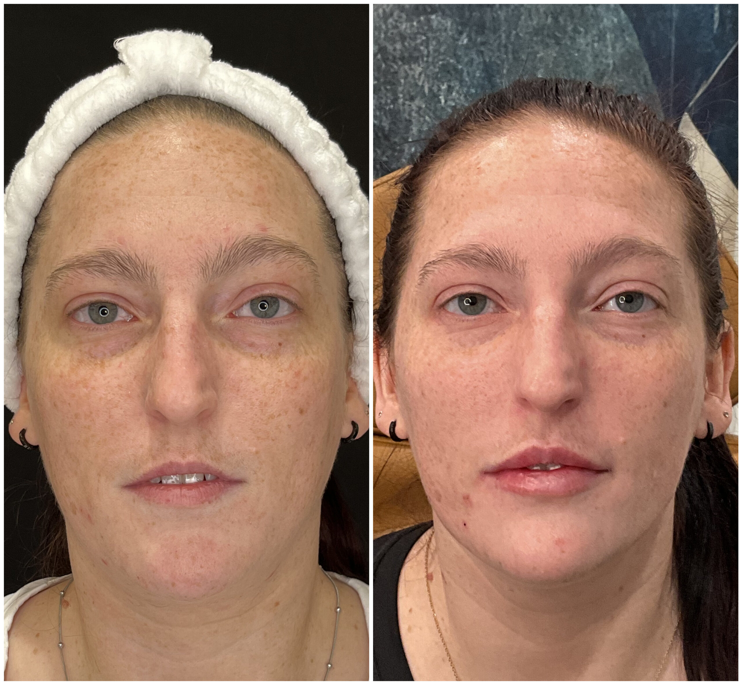 Lip filler results at Frisco Beauty Nurse
