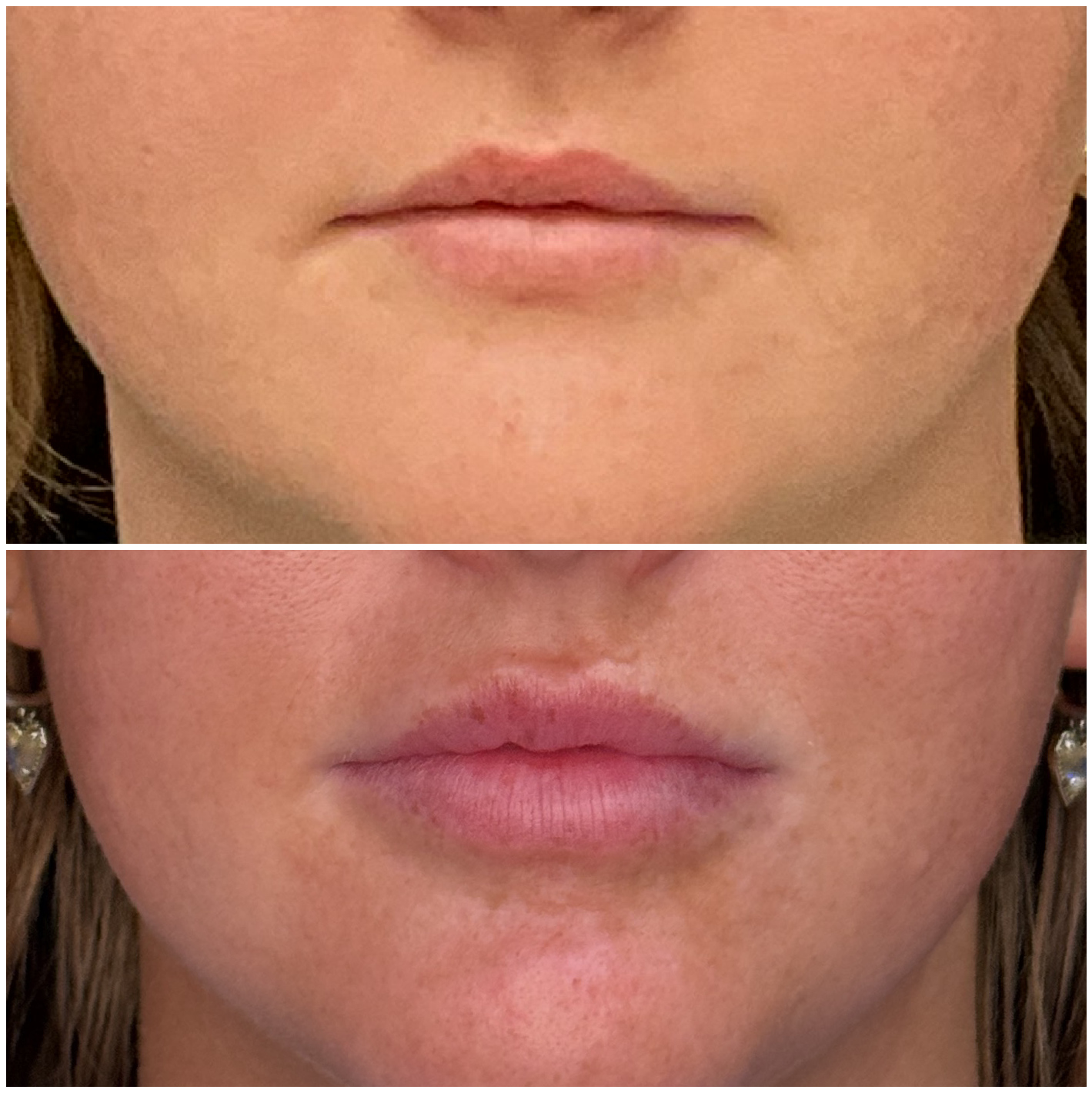 Dermal filler treatment at Frisco Beauty Nurse