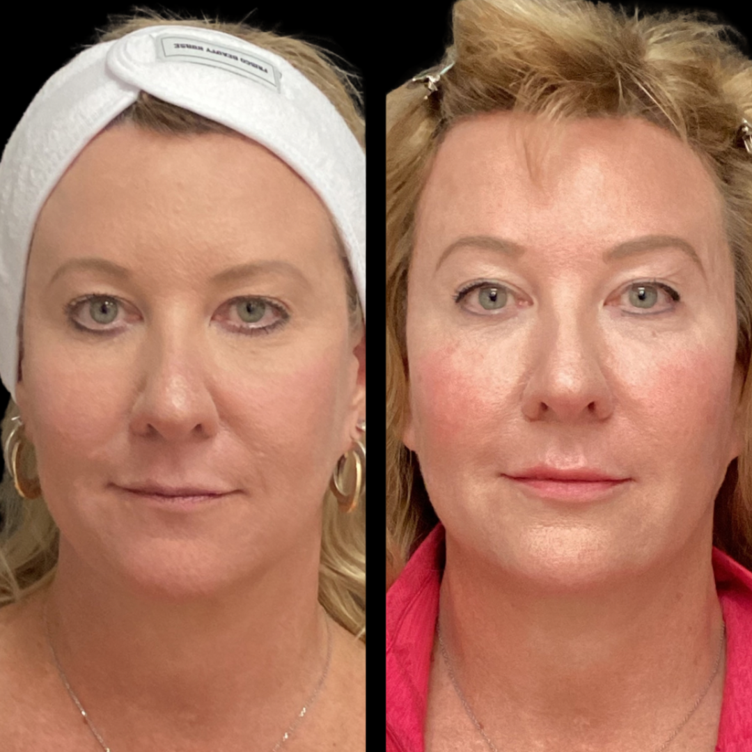 Age spots and uneven tone treatment planning in Frisco TX