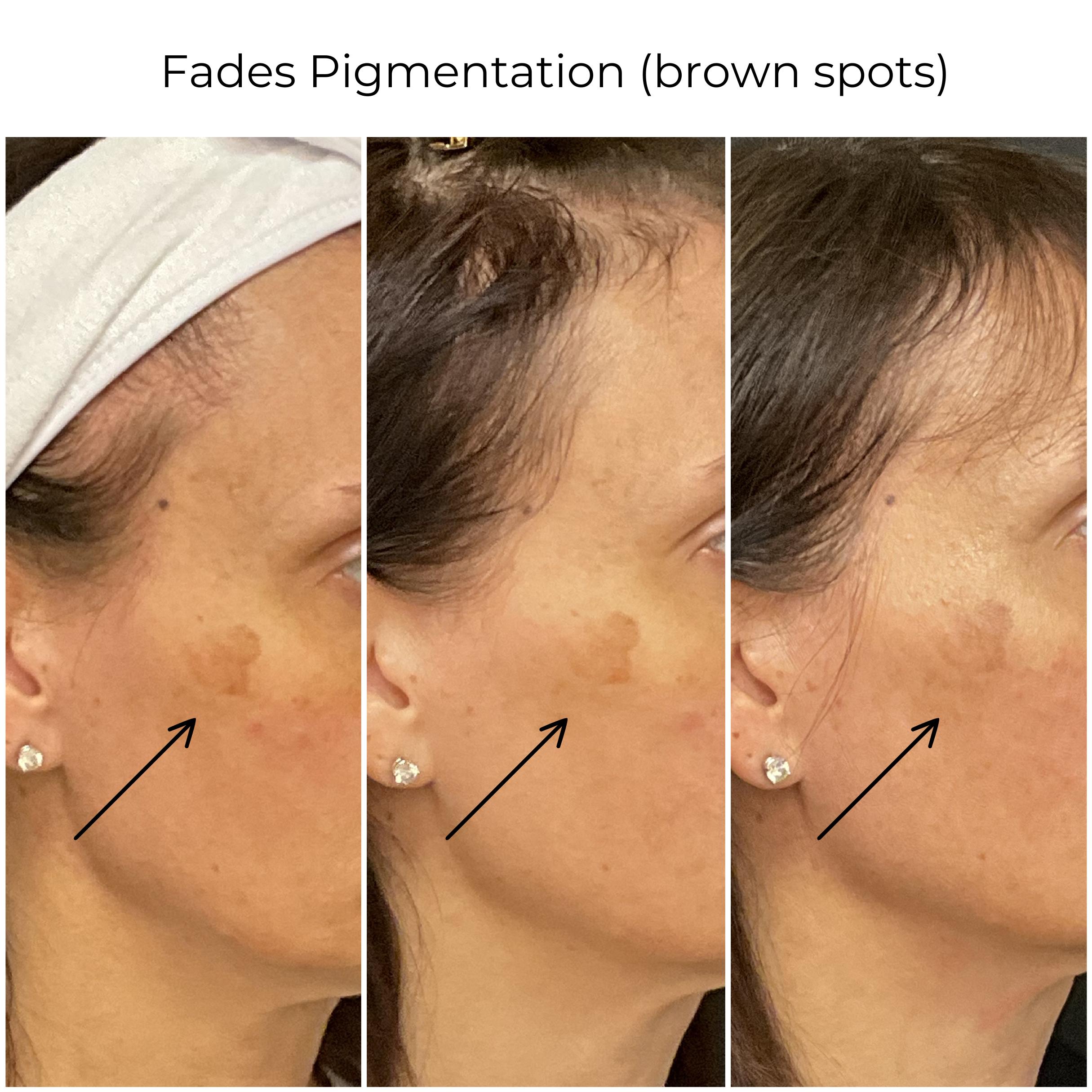 Age spots and uneven tone treatment planning in Frisco TX